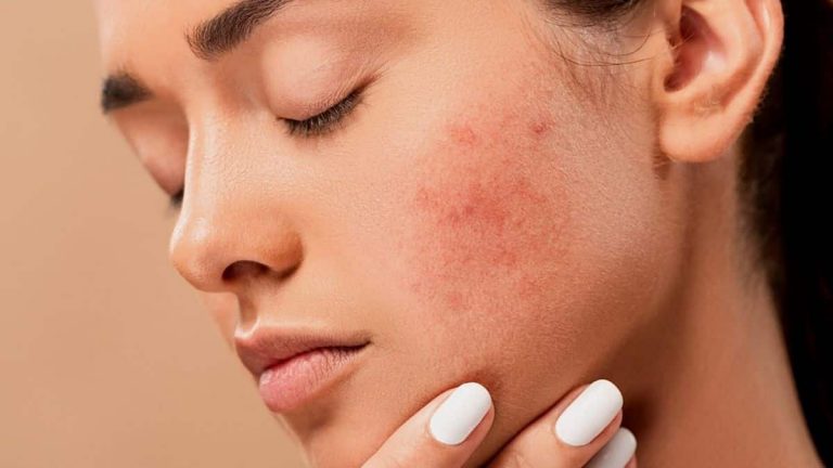 How to Clear Acne Scars [Naturally and Organically]