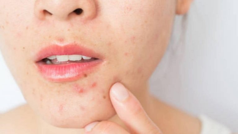 Best Korean Skincare For Acne Scars [This is how you can get rid of acne scars fast]