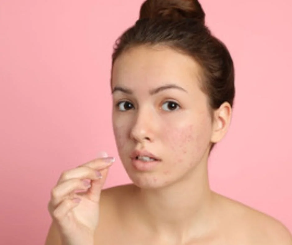 Can Korean skincare help acne