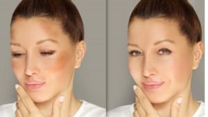 Best makeup to cover Melasma on the upper lip