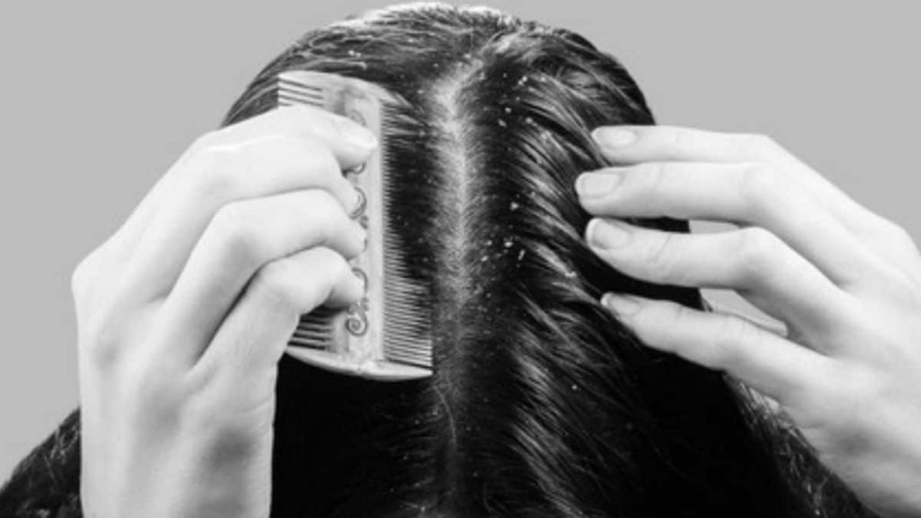 how-to-remove-dandruff-without-washing-hair-reenasidhu